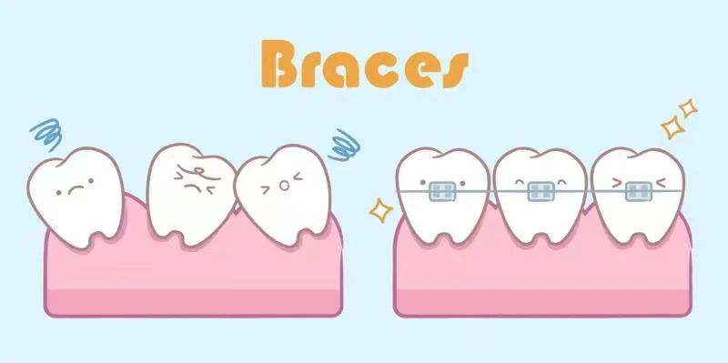 牙齿矫正-1