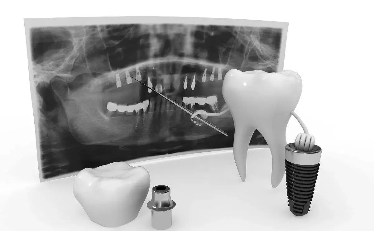 种植牙不入医保-4